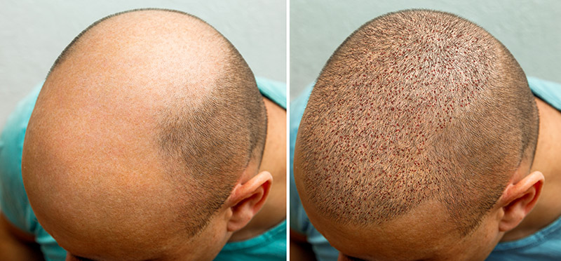 Hair Transplant - Before and After