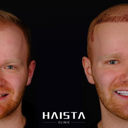 Are Hair Transplant Scars Permanent? - Haista Clinic