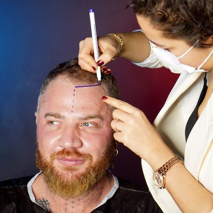 Can Hair Transplant Thicken Hair? - Haista Clinic