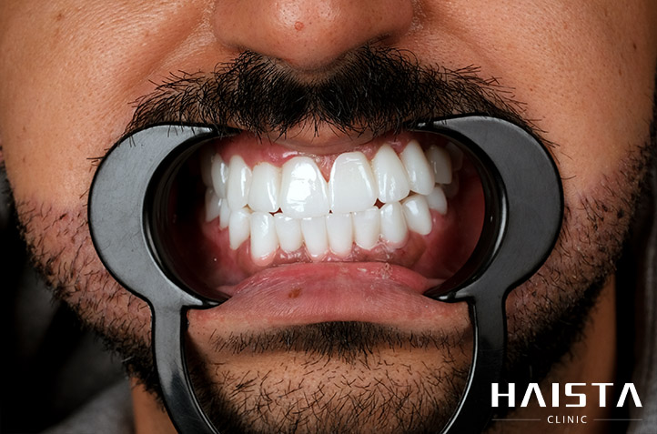 Dental Implant Operation - Haista Clinic Dental implant