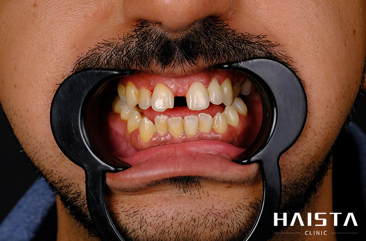 Dental Implant Operation - Haista Clinic Dental implant